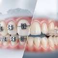 Braces And Aligners Treatment For A Perfect Smile