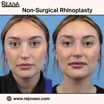 New York, Beautician, Non-surgical Rhinoplasty Newport Beach For Natural Enhancement
