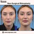 Non-surgical Rhinoplasty Newport Beach For Natural Enhancement