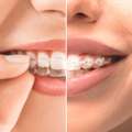 Best Invisible Dental Braces In Jaipur For Perfect Smile