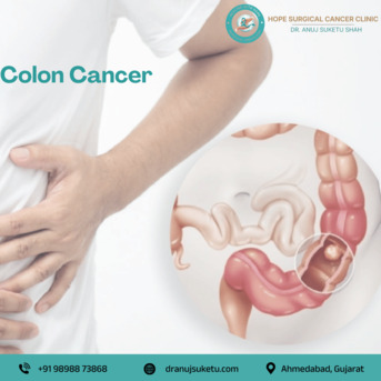 Ahmedabad, Health, Experienced Colon Cancer Surgeon In Ahmedabad For Personalized Care