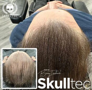 London, Beautician, Scalp Micropigmentation For Long Hair - Skulltec