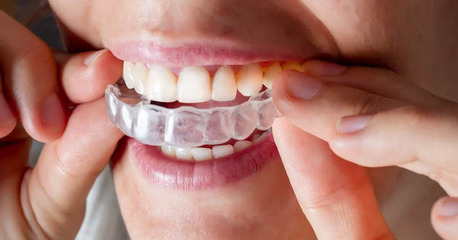 Mumbai, Dental, Premier Invisalign Provider In Trivandrum: Transform Your Smile With Expert Clear Aligners