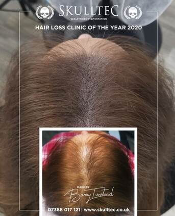 London, Beautician, Scalp Micropigmentation For Women &ndash; Restore Confidence With Skulltec