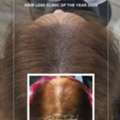 Scalp Micropigmentation For Women &ndash; Restore Confidence With Skulltec