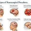 Advanced Techniques Used In Modern Brain & Spine Treatment