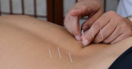 Jumeirah, Medical, Acupuncture Therapy