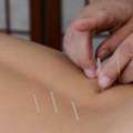 Acupuncture Therapy