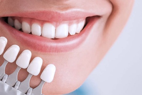 Surrey, Dental, Veneers Surrey BC