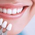 Veneers Surrey BC