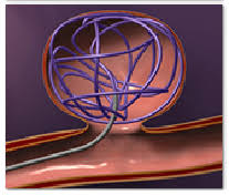 Punjab, Health, Coiling Surgery For Safe And Precise Aneurysm Treatment