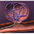 Coiling Surgery For Safe And Precise Aneurysm Treatment