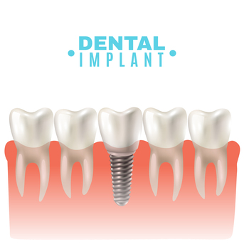 Mumbai, Health, How Long Do Dental Implants Last?