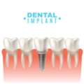 How Long Do Dental Implants Last?