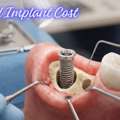What Really Decides Dental Implant Cost In Mumbai?