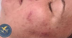 Sydney, Education, Is Microneedling Facial Good For Clearer Skin?