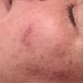 Is Microneedling Facial Good For Clearer Skin?