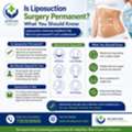 Is Liposuction Surgery Permanent? What You Should Know
