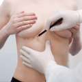 Breast Enlargement Solutions For Natural Looking Results