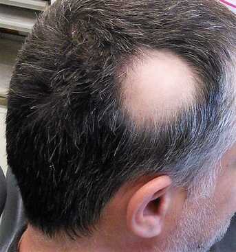 London, Health, Effective Scalp Micropigmentation For Alopecia &ndash; Skulltec