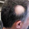 Effective Scalp Micropigmentation For Alopecia &ndash; Skulltec
