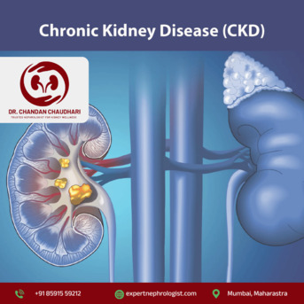 Mumbai, Health, Best Chronic Kidney Disease Treatment In Mumbai | Expert Kidney Care