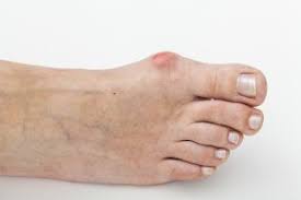 Singapore, Health, 5 Advantages Of Bunions On Feet