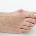 5 Advantages Of Bunions On Feet