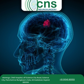 Ahmedabad, Health, Brain Tumor Surgery In Ahmedabad &ndash; Dr. Chirag Solanki