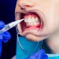 Advanced Gum Grafting In Beverly Hills For Healthier Smiles