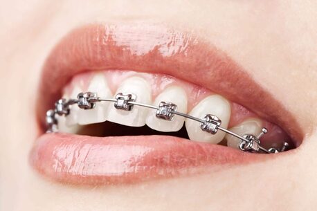 New Delhi, Dental, Dental Braces Treatment In East Delhi