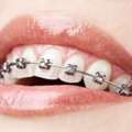 Dental Braces Treatment In East Delhi