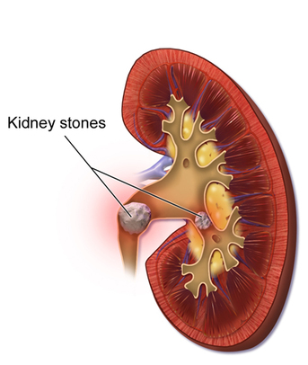 Gurugram, Health, Kidney Stone Treatment Cost In South City-2