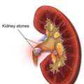Kidney Stone Treatment Cost In South City-2