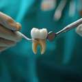 Safe & Painless Wisdom Tooth Removal In GTB Nagar
