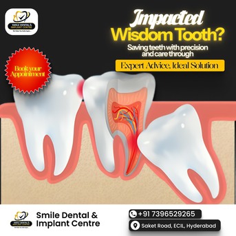 Hyderabad, Dental, Painless Wisdom Teeth Extraction In Sainikpuri - Expert MDS Surgeons