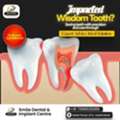 Painless Wisdom Teeth Extraction In Sainikpuri - Expert MDS Surgeons