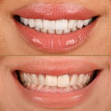 Dubai, Dental, Cosmetic Dentistry Dubai &ndash; Veneers, Invisalign & Smile Makeover
