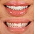 Cosmetic Dentistry Dubai &ndash; Veneers, Invisalign & Smile Makeover