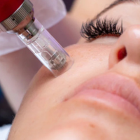 New York, Beautician, Aquagold Facials Fort Collins Advanced Skin Rejuvenation