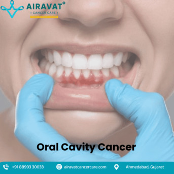 Ahmedabad, Health, Trusted Oral Cavity Cancer Treatment In Ahmedabad - Airavat Cancer Care