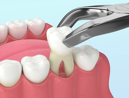 New York, Dental, Trusted Dental Extraction Care For Lasting Oral Relief