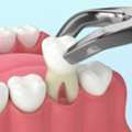 Trusted Dental Extraction Care For Lasting Oral Relief