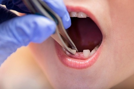 New York, Dental, Trusted Dental Extraction Care For Lasting Oral Relief