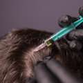 PRP In Islamabad - Royal Cosmetic Surgery