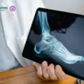 Fracture Healing Natural Remedies