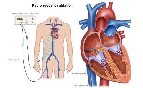 Abu Dhabi, Health, Why Choose The Heart.ae For SVT Ablation Abu Dhabi Treatment?