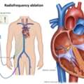 Why Choose The Heart.ae For SVT Ablation Abu Dhabi Treatment?