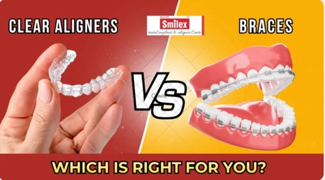 Pune, Dental, Clear Aligners Cost Vs Braces Cost In India | Detailed Comparison Guide