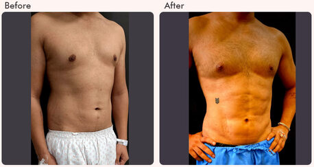 New Delhi, Health, Six Pack Abs Surgery In Delhi - Dr Rajat Gupta